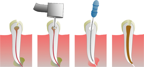 Quy trình Điều Trị Tủy răng để hiểu hơn Lấy Tủy Răng mất bao lâu Thời gian