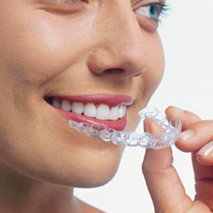 Niềng Răng Không Nhổ Răng là gì và Hiệu quả tốt không khi dùng Khay Nhựa trong suốt công nghệ Invisalign