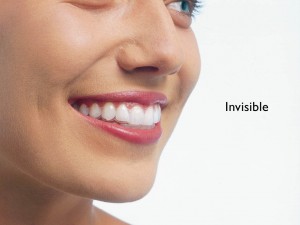 Hình minh họa Tại sao niềng răng Invisalign có chi phí cao nhất - Khay Niềng Răng Invisalign Sau Khi Gắn Vào Răng Bệnh Nhân