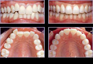 Niềng Răng Không Nhổ Răng Trước và sau điều trị