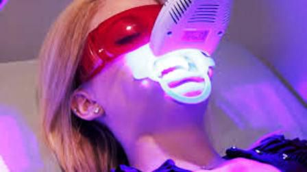 Tẩy trắng răng đèn Laser/ plasma