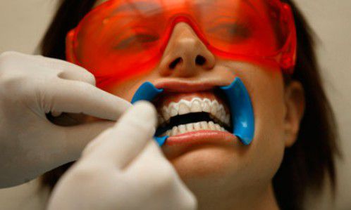 Tẩy Trắng răng an toàn Hiệu quả bằng đèn Laser trước khi thực hiện