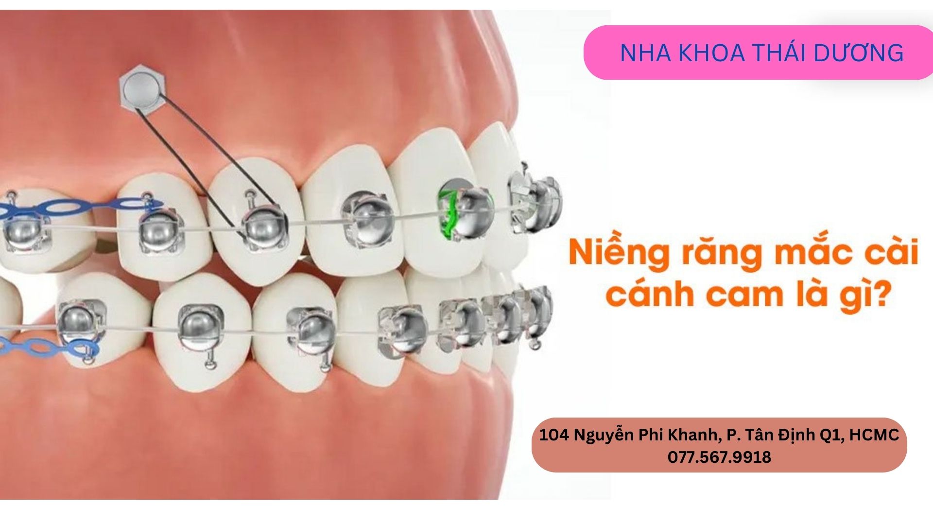 Niềng Răng Mắc Cài CÁNH CAM